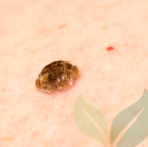 Lesion Removal CliniSculpt 1