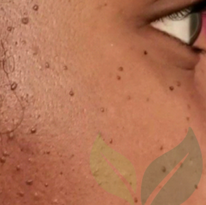 Lesion Removal CliniSculpt 2