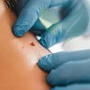 Lesion Removal CliniSculpt 3