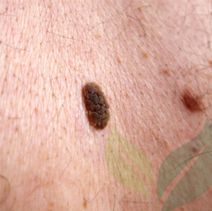 Lesion Removal CliniSculpt 6
