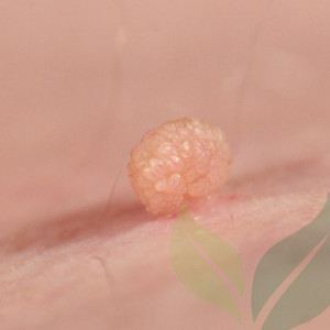 Lesion Removal CliniSculpt 7