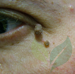 Lesion Removal CliniSculpt 8